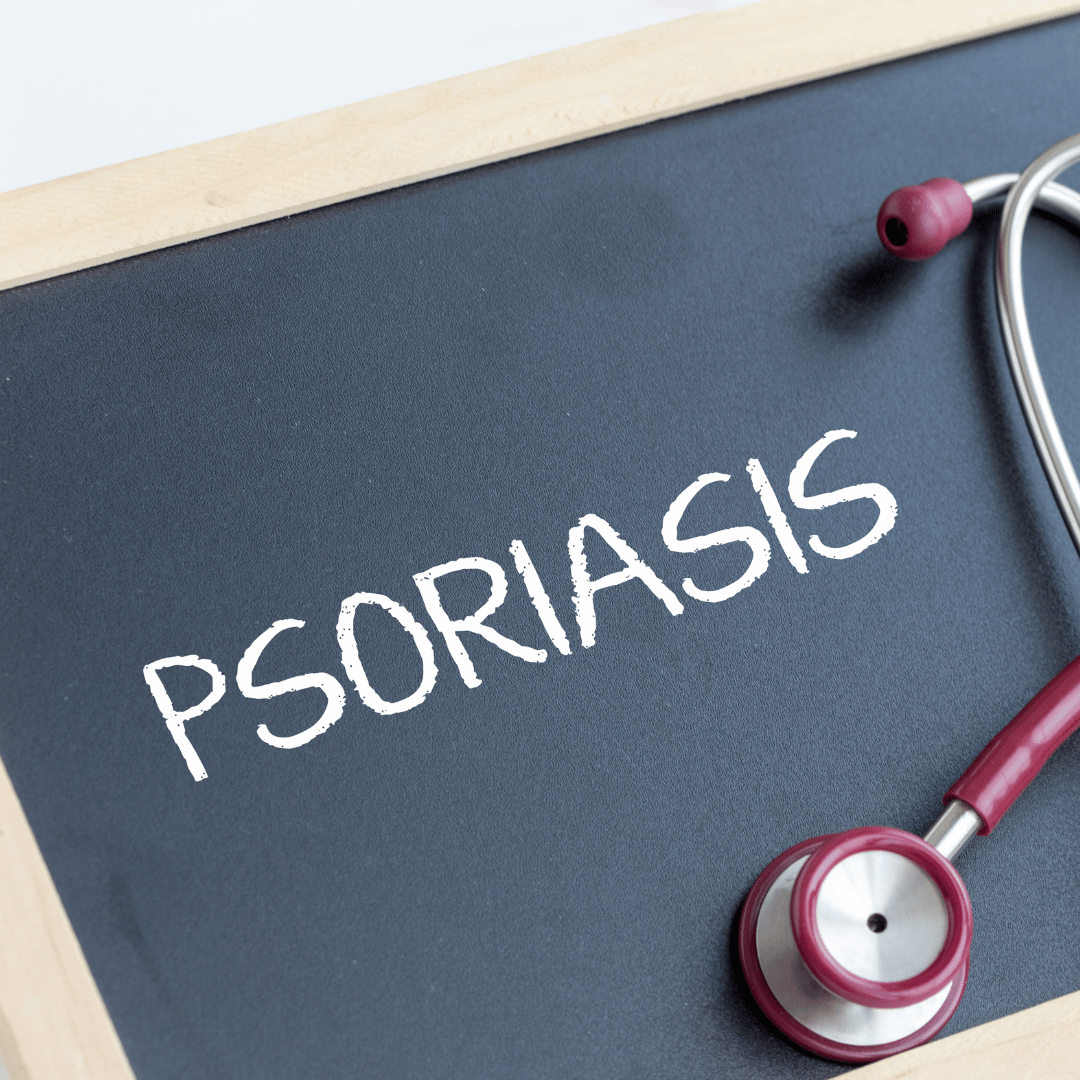 Tout savoir sur le psoriasis du cuir chevelu